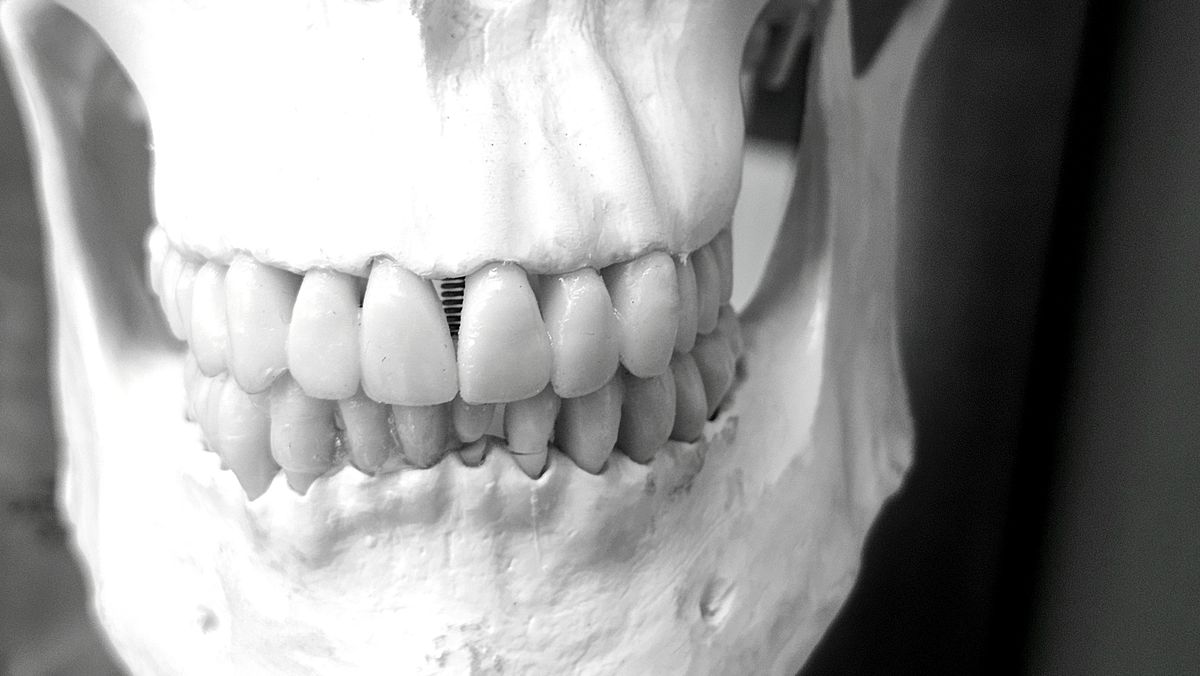 Proces wszczepiania implantu zęba pokazany na modelu szczęki